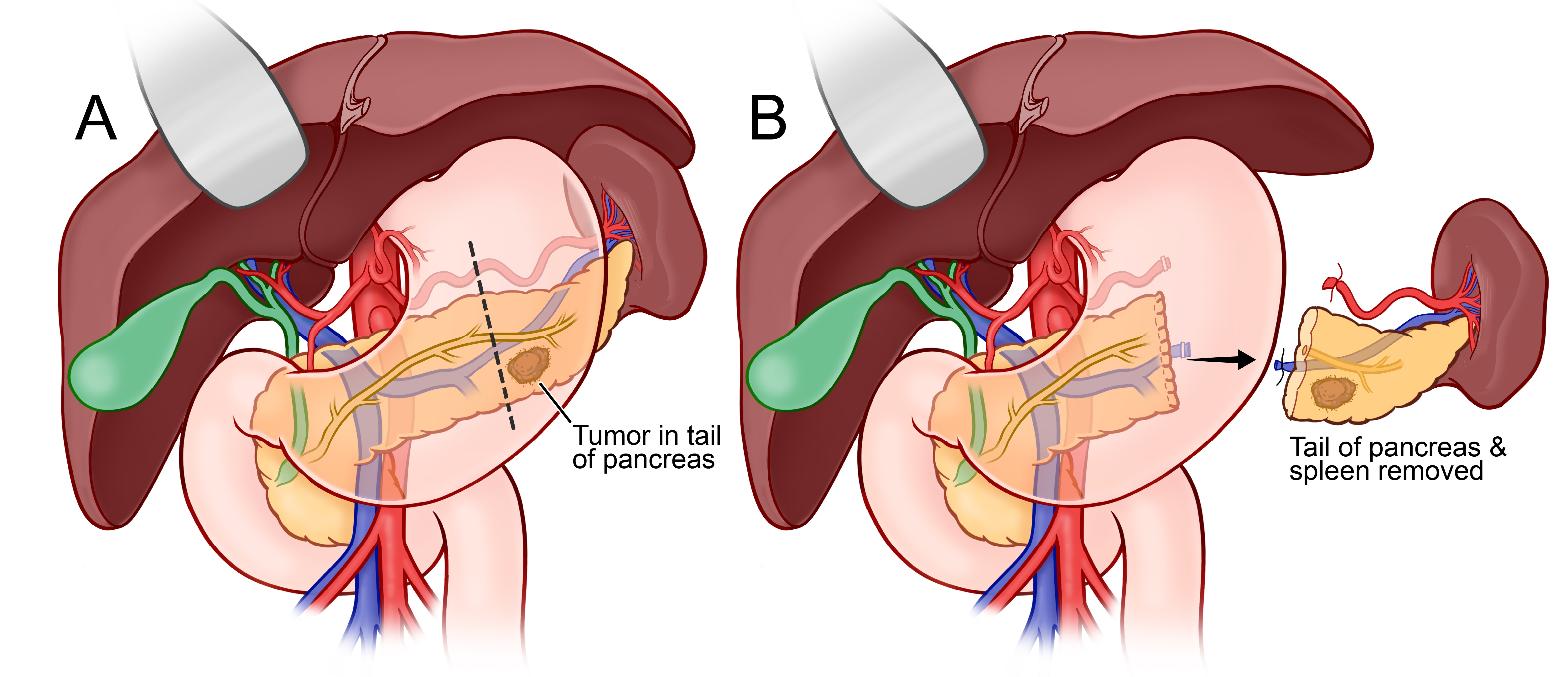 Diagram showing what is removed in a distal pancreatectomy