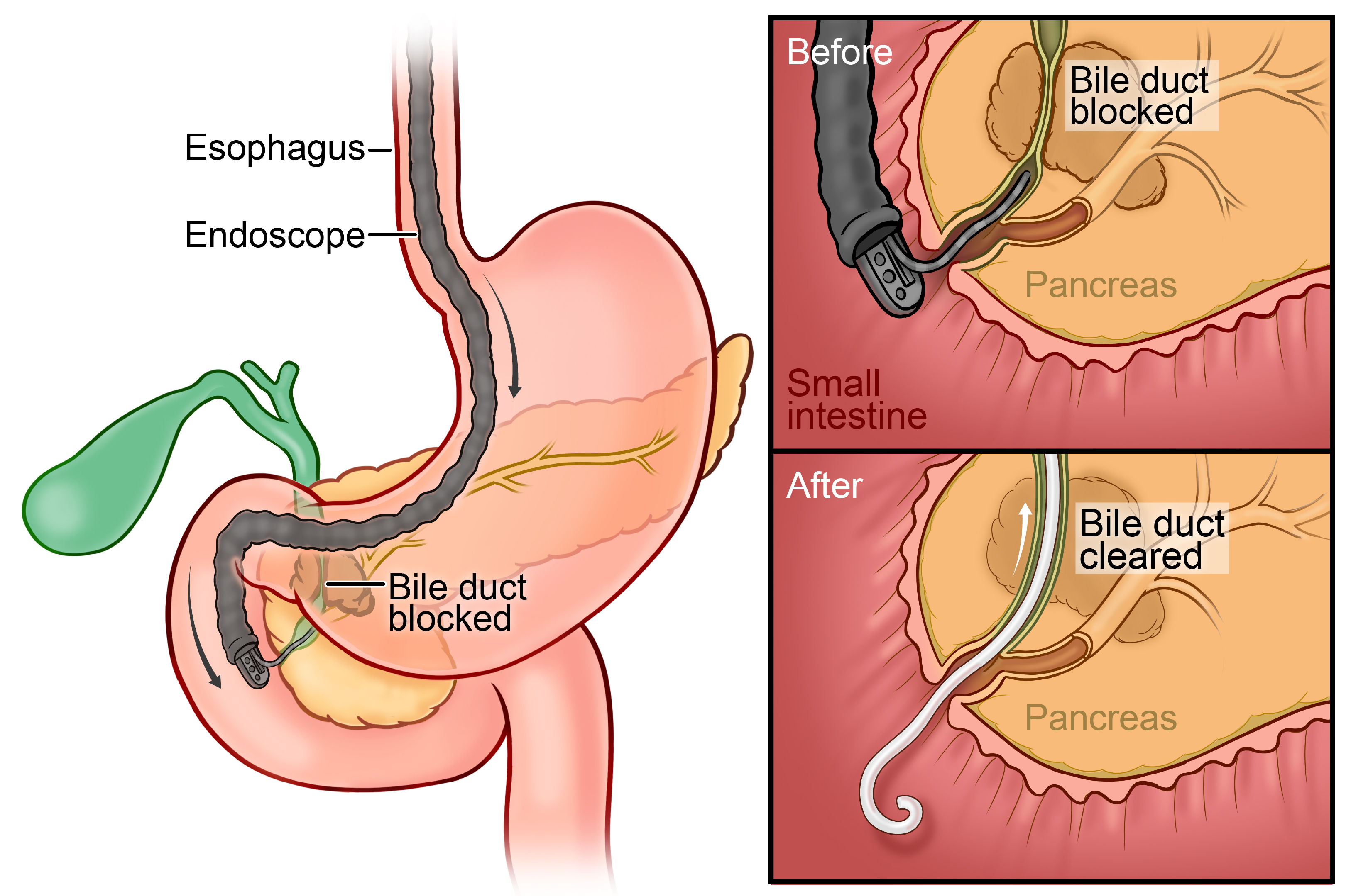 Diagram of ERCP biliary stent placement