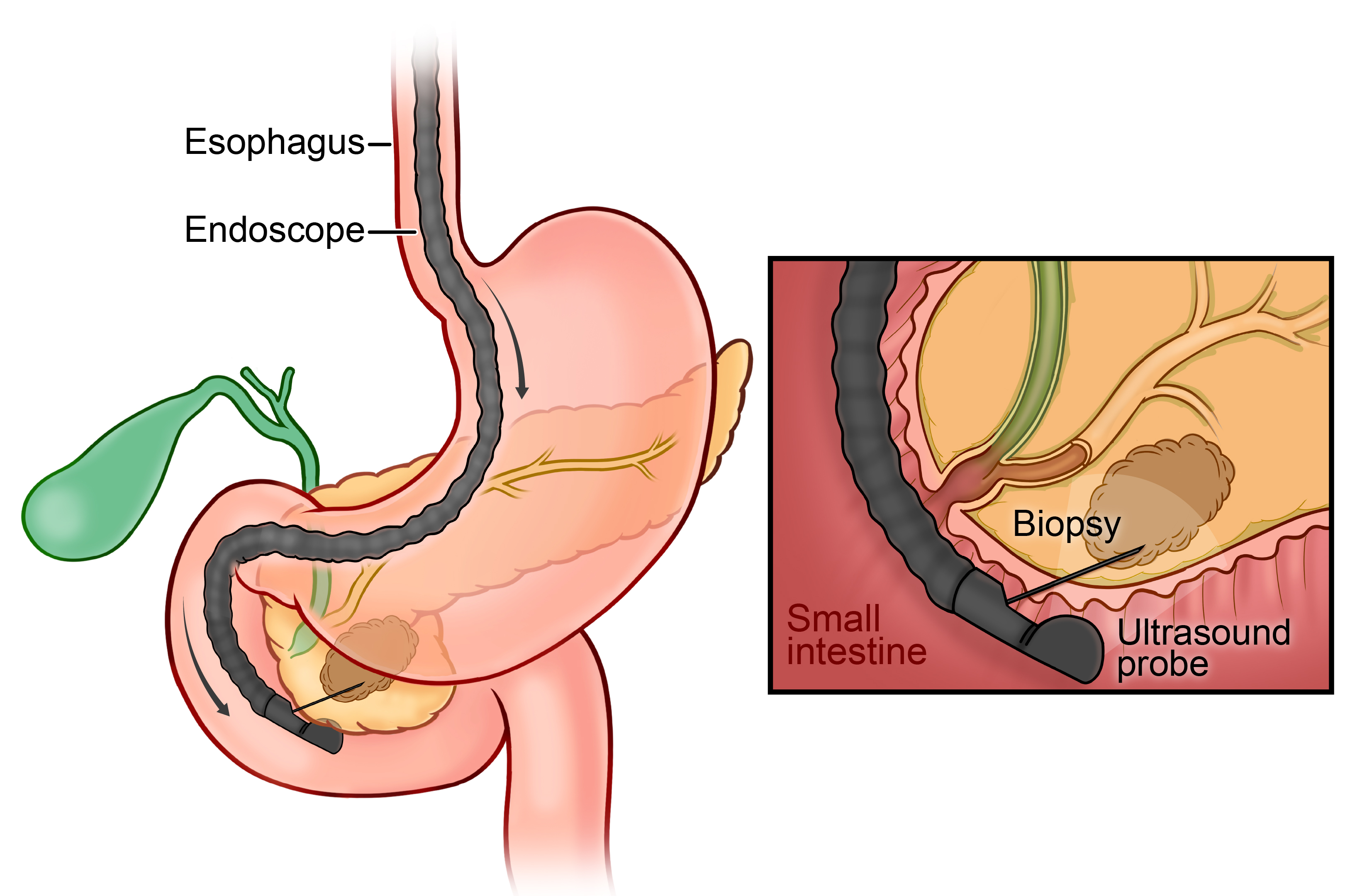 Diagram of endoscopic ultrasound