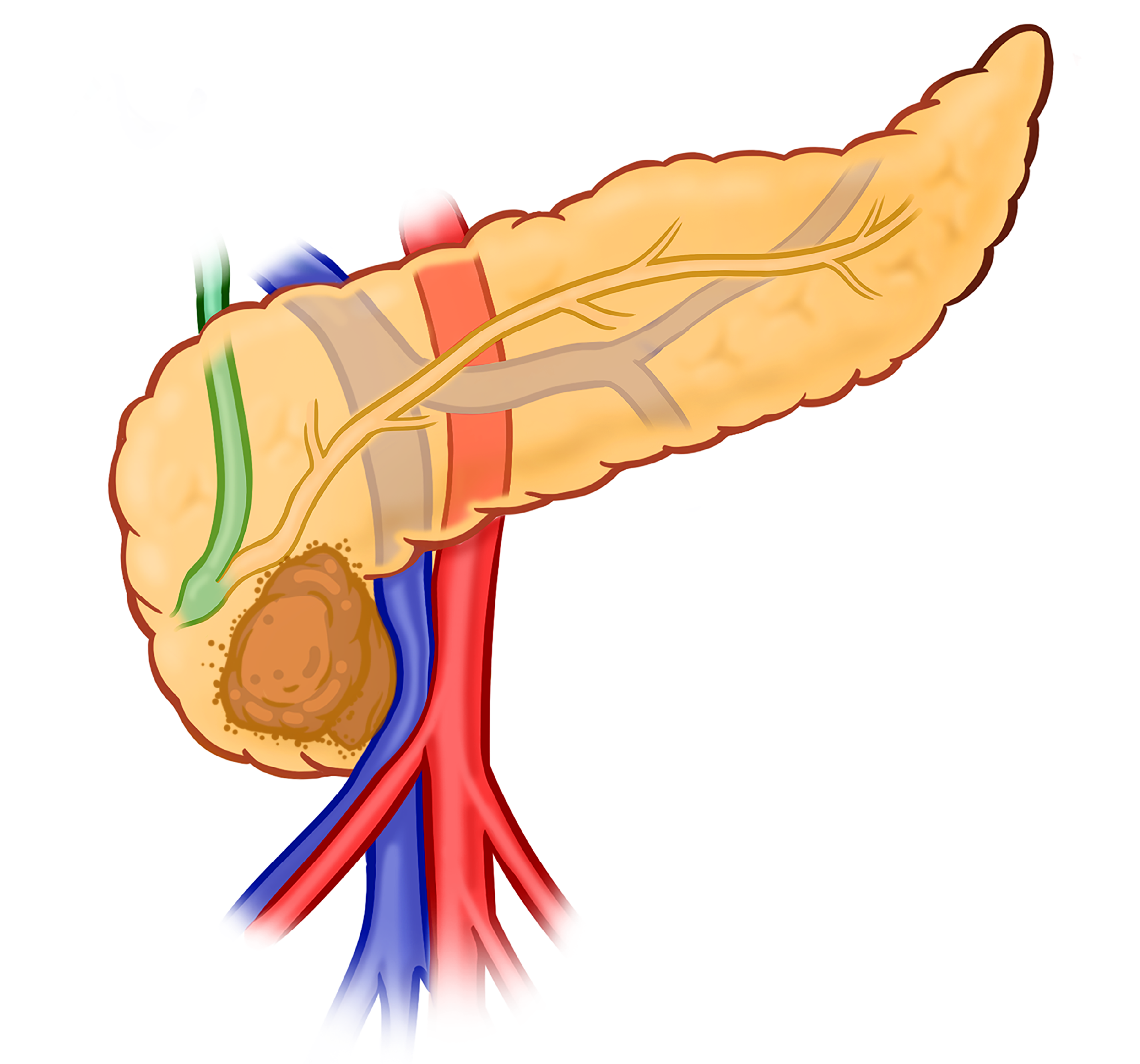 Illustration of borderline resectable pancreatic cancer: tumor abuts but does not encase major vessels