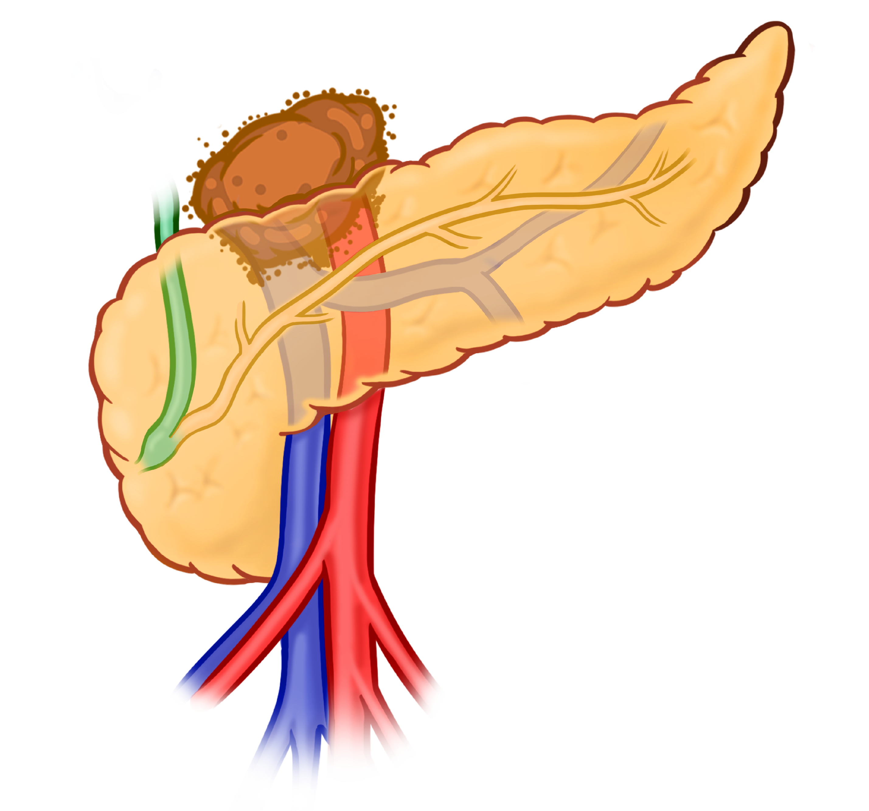 Illustration of locally advanced pancreatic cancer: extensive vascular involvement precludes resection