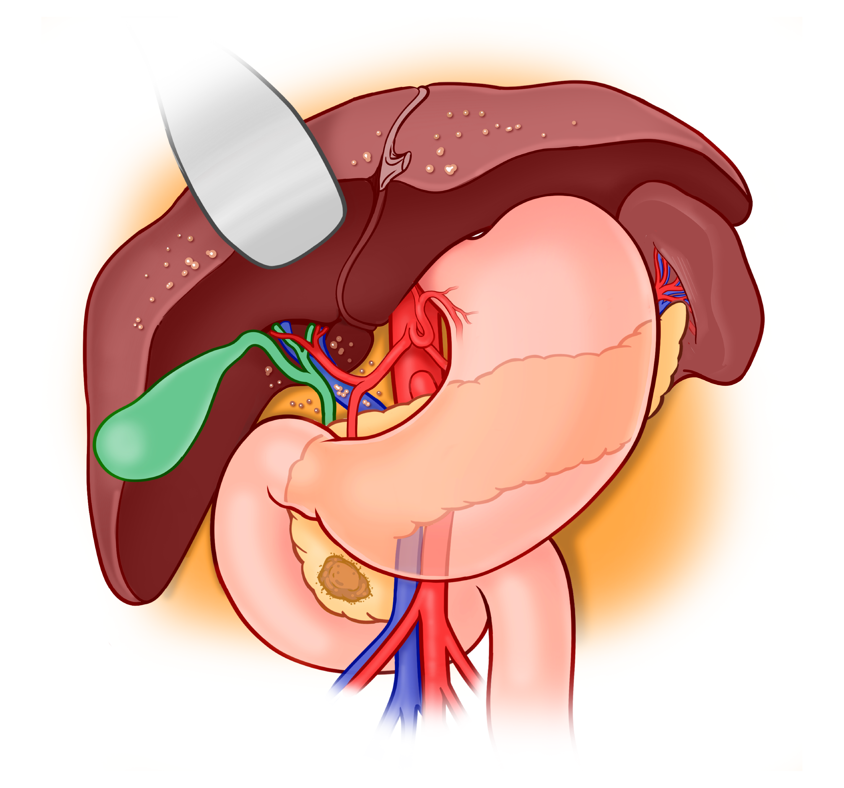 Illustration of metastatic pancreatic cancer: disease spread beyond the pancreas to other organs