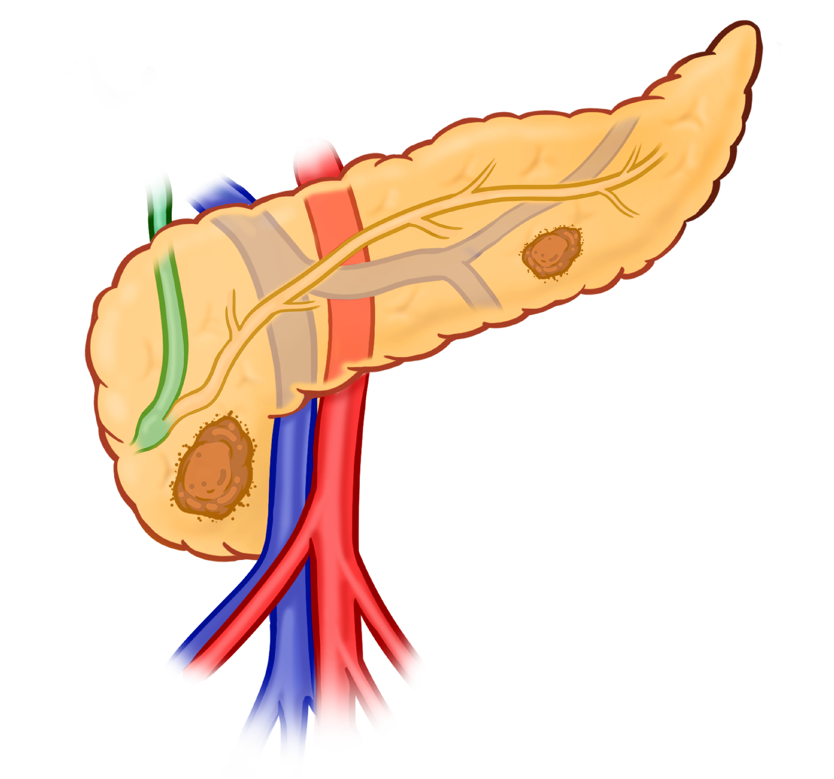 Illustration of resectable pancreatic cancer: tumor does not involve major blood vessels