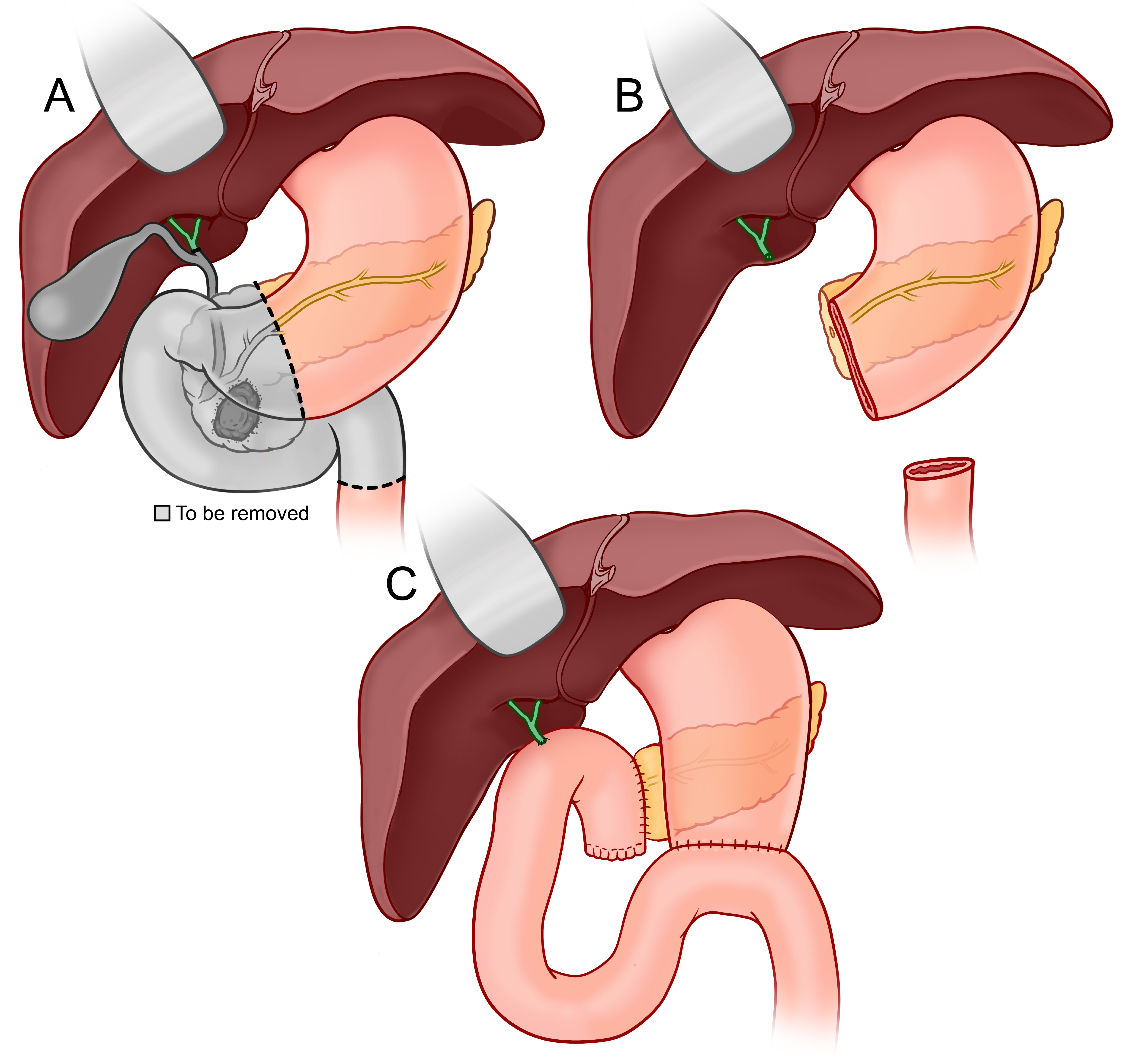 Diagram showing what is removed and how organs are reconnected in the Whipple procedure